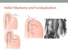 Heller Myotomy and Fundoplication