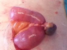 Strangulated small bowel hernia