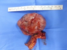 GIST tumor of small bowel (resected specimen)