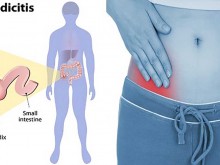 Appendicitis Signs and Symptoms